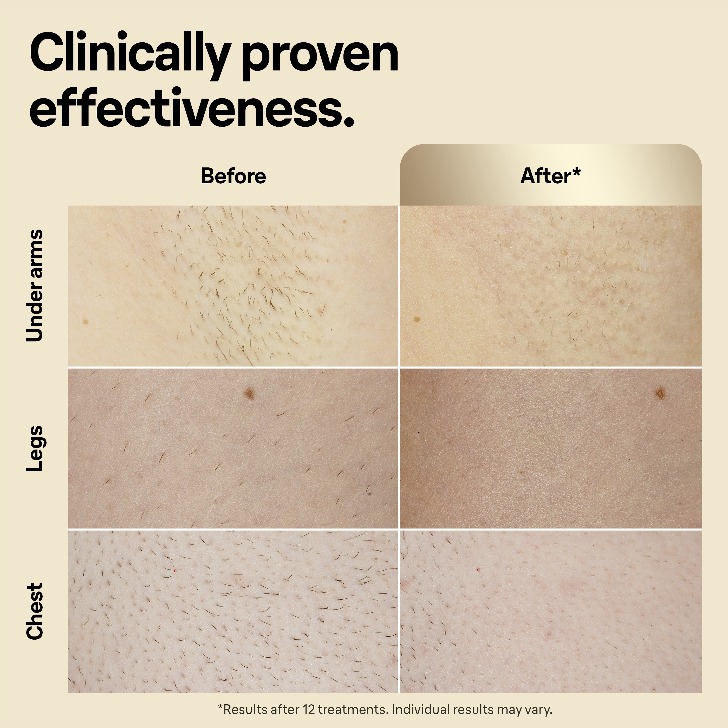 Braun IPL Silk·expert Pro 5 PL5242 IPL-laite